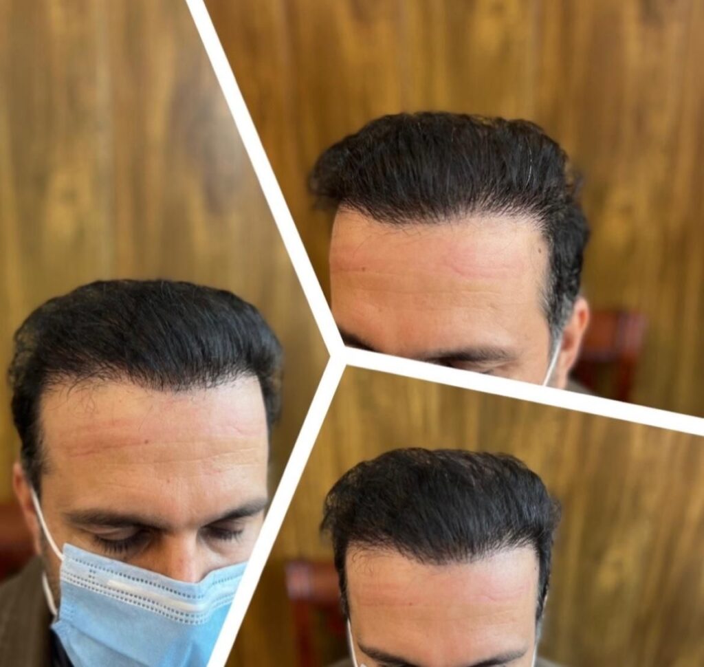 کاشت مو با ضمانت فقط ۸ میلیون