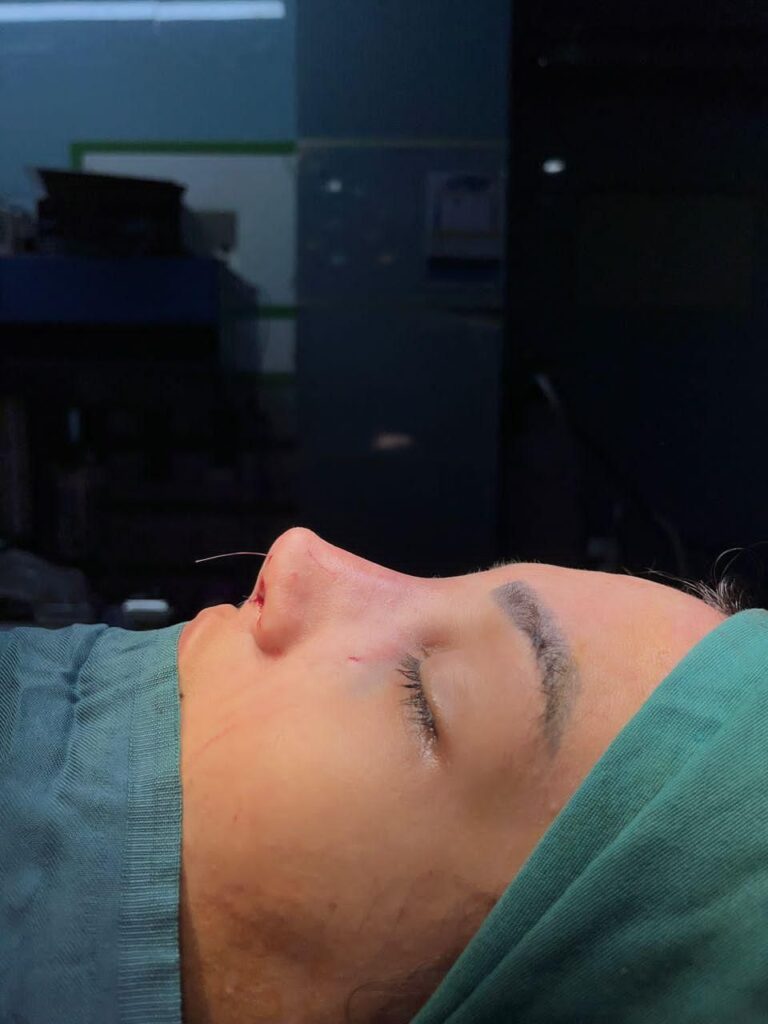 جشنواره بهاره عمل بینی توسط متخصص زیبایی