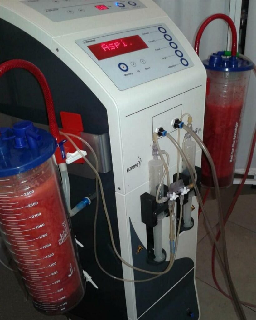 لیپوماتیک پیکرتراشی لاغری ژنیکوماستی تزریق ژل چربی