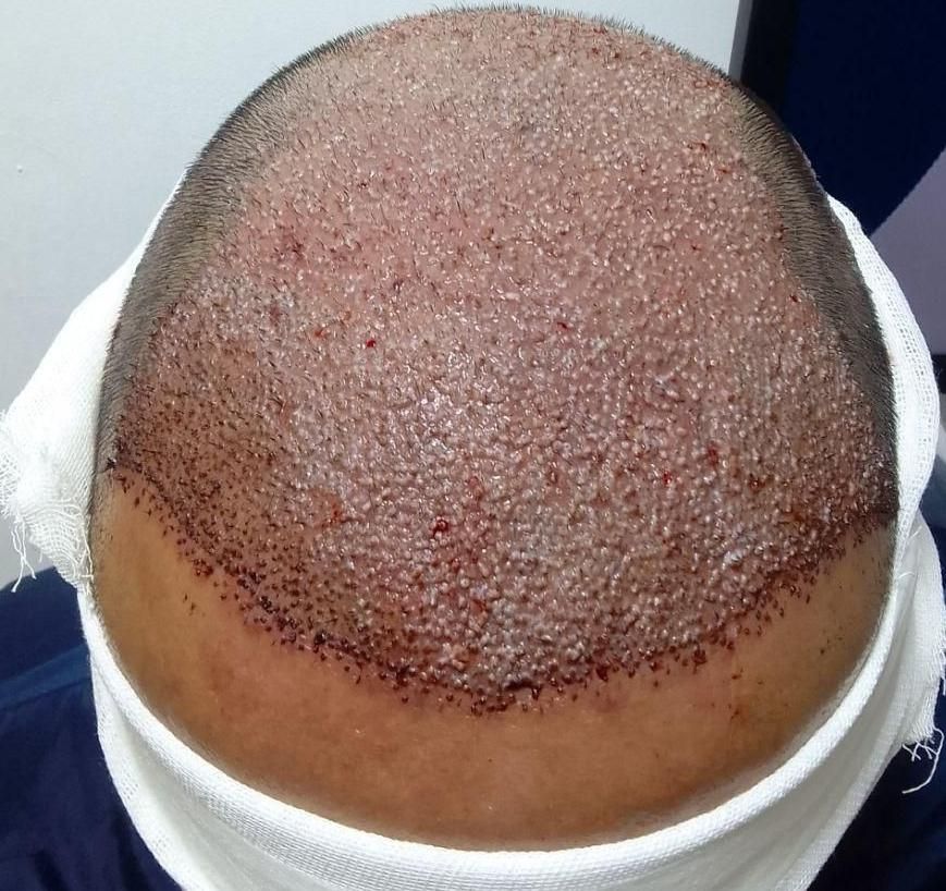 کاشت تخصصی مو و ابرو و ریش