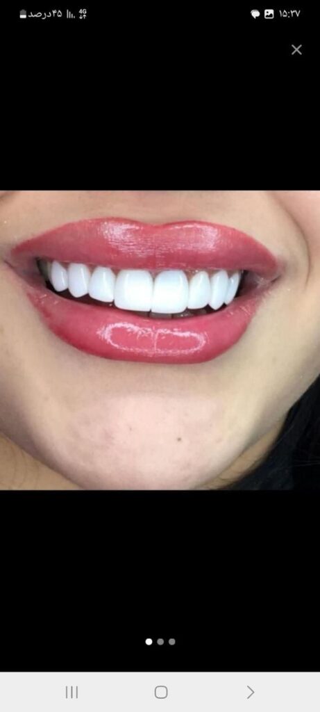 کامپوزیت دندان